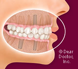 dental-implants2