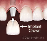 dental-implants6