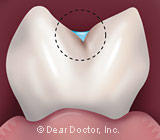 dental-sealants2