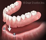 dentures2