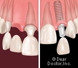 implants-vs-bridgework3