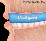 mouthguard10