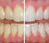 teeth-whitening4