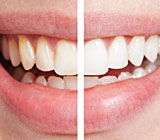 teeth-whitening6