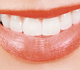 teeth-whitening8