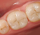 tooth-colored-fillings3