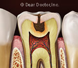 tooth-decay-cross-section4