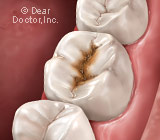 tooth-decay-illustration