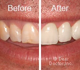 veneers-before-after3