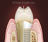 Factors that Can Influence a Dental Implant | Welcome to DeWitt Dentistry